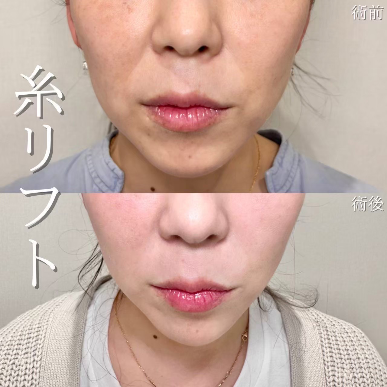 糸リフト