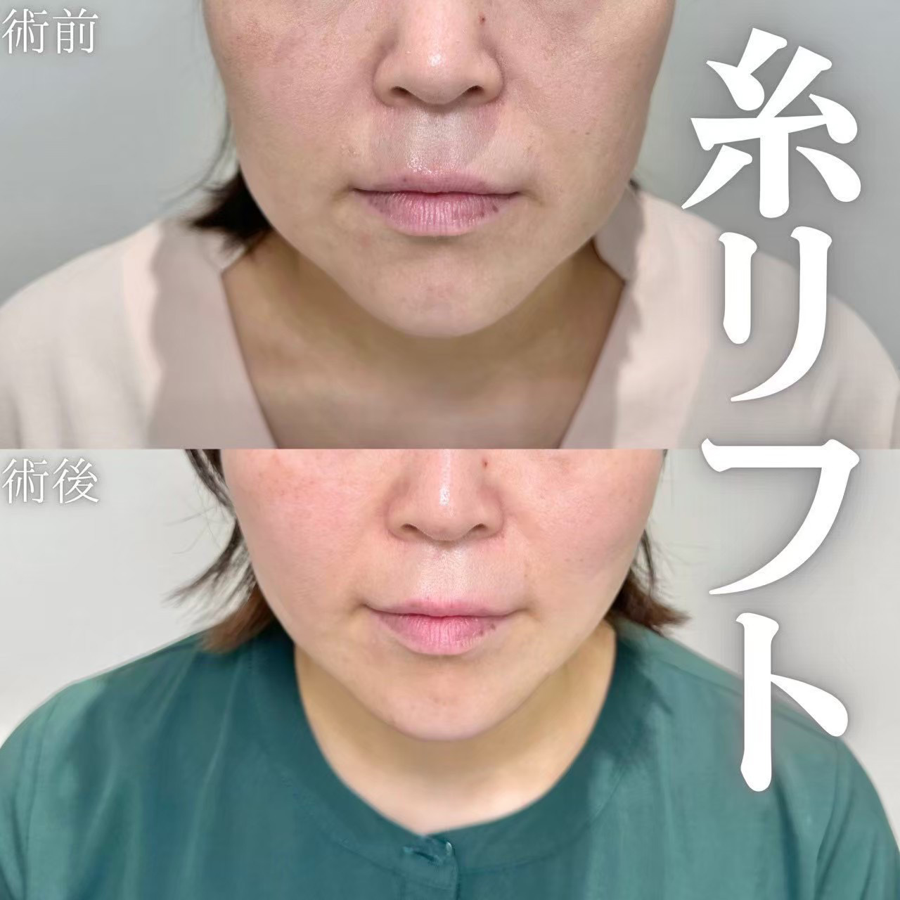 糸リフト
