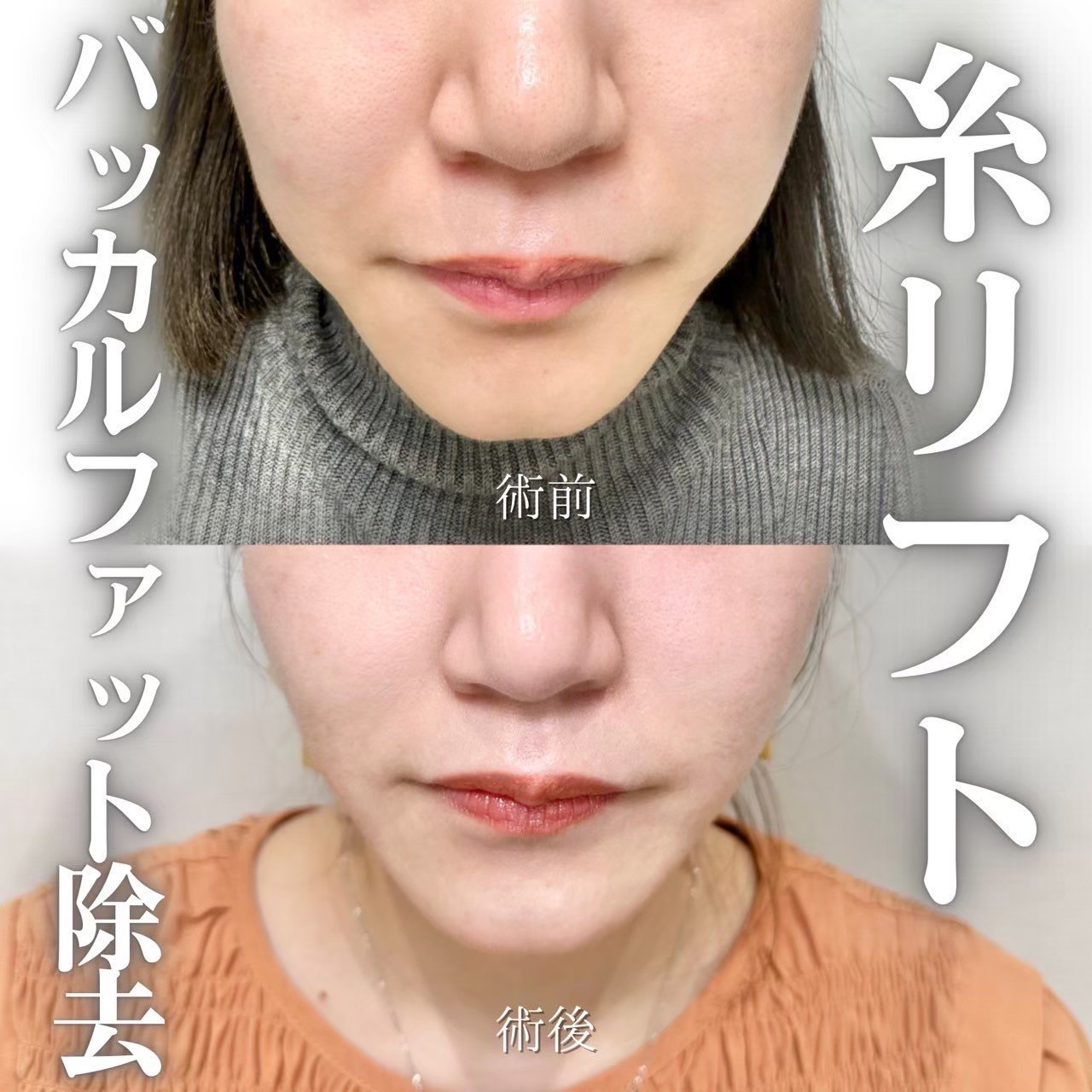 糸リフト
