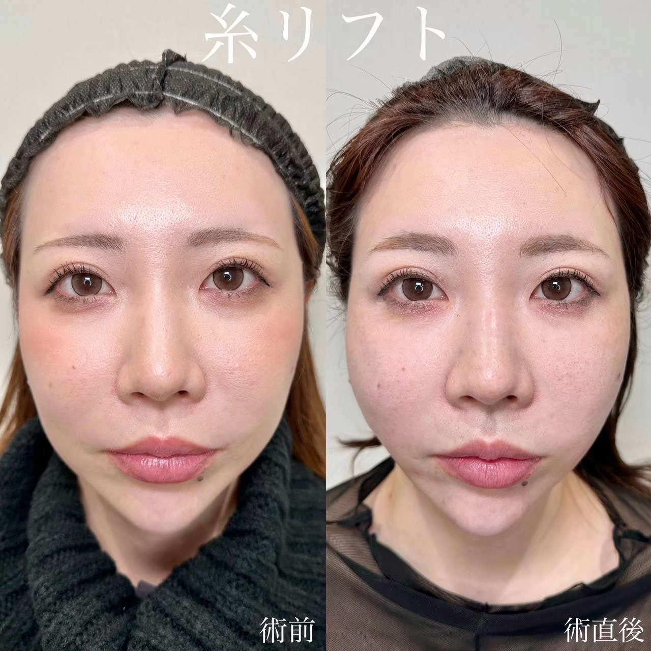 糸リフト