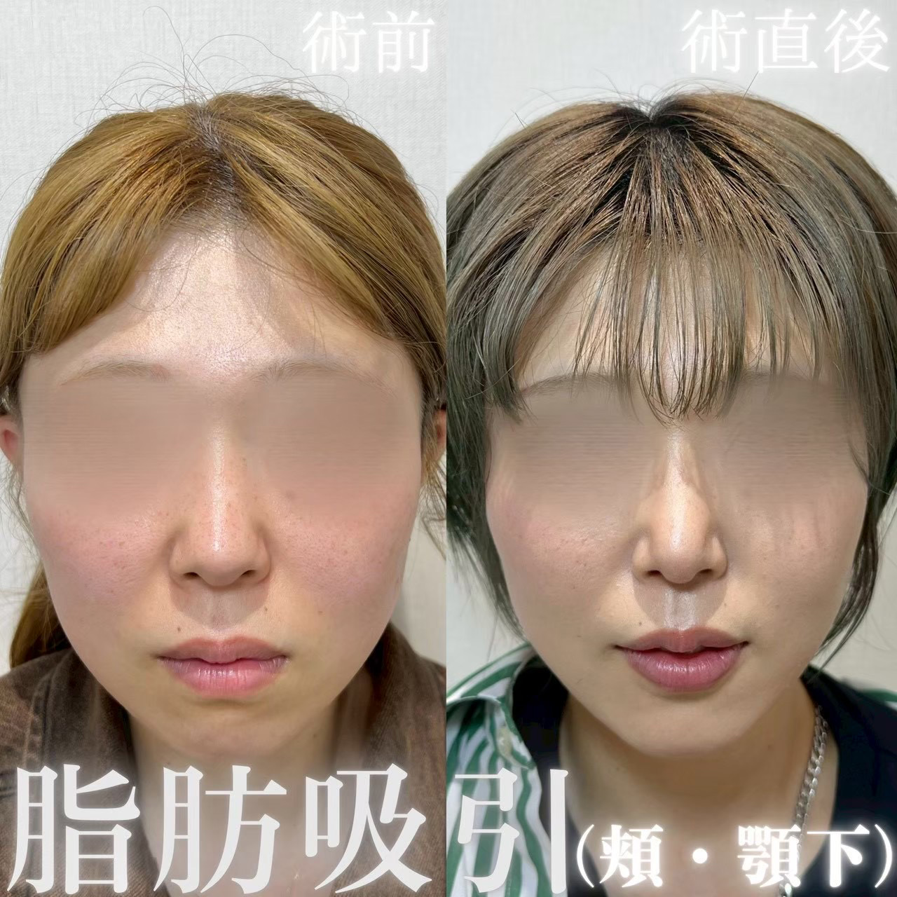 脂肪吸引(頬・顎下)
