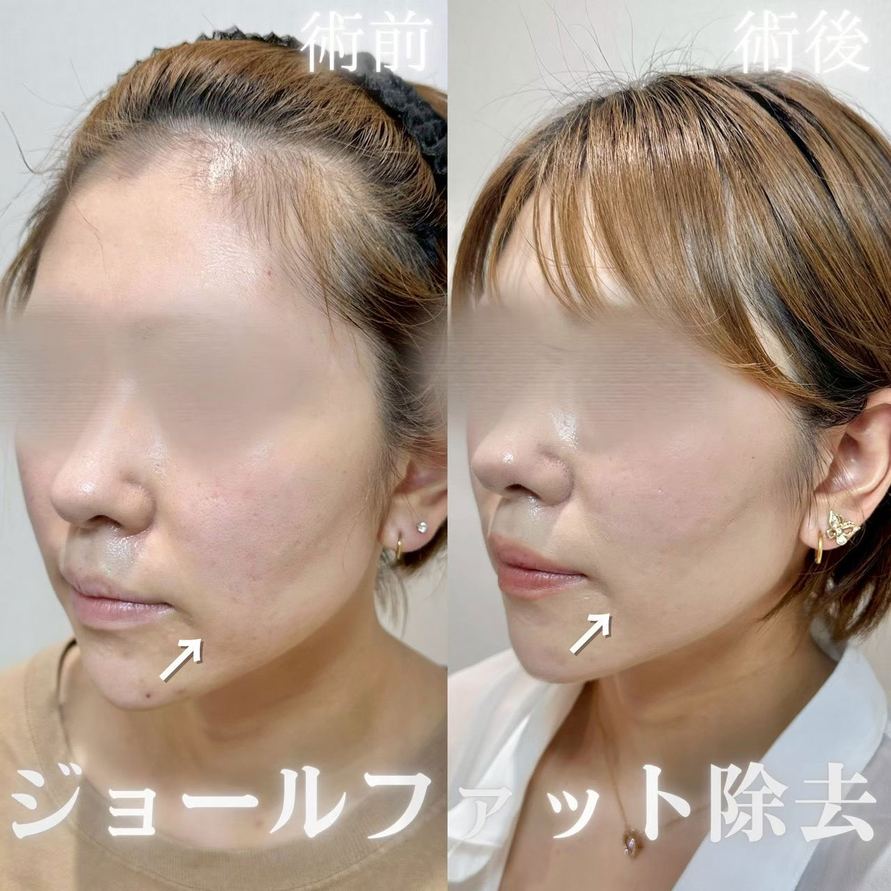 バッカルファット除去