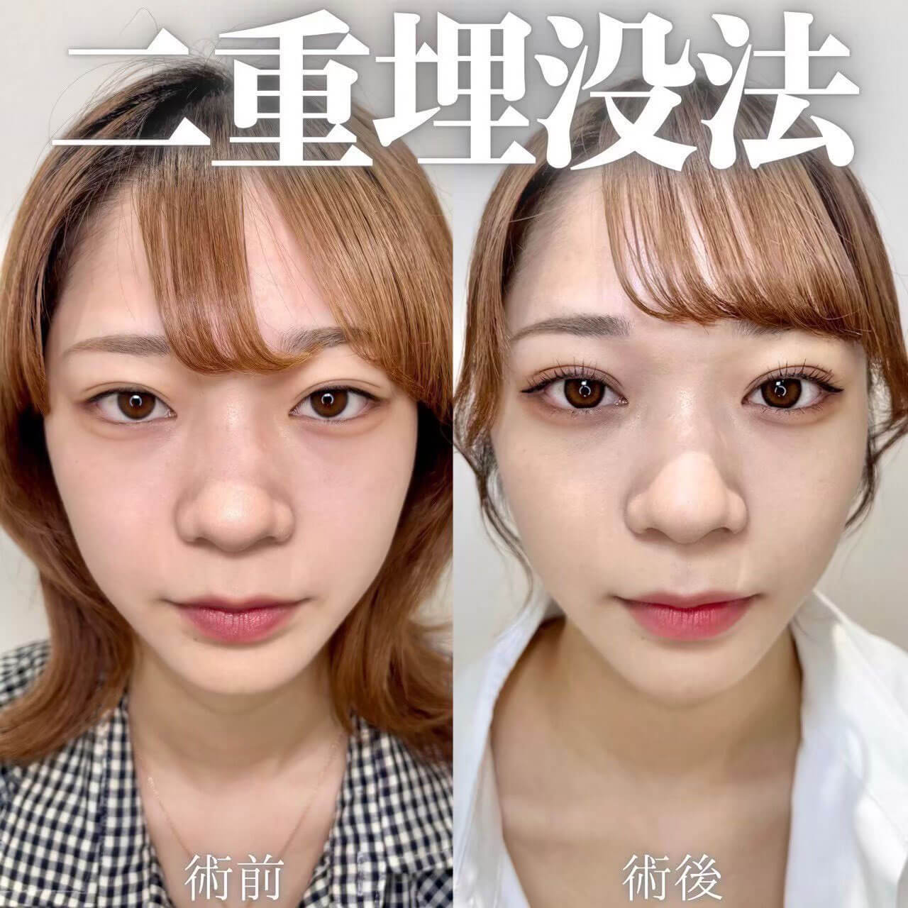 二重埋没法 症例04
