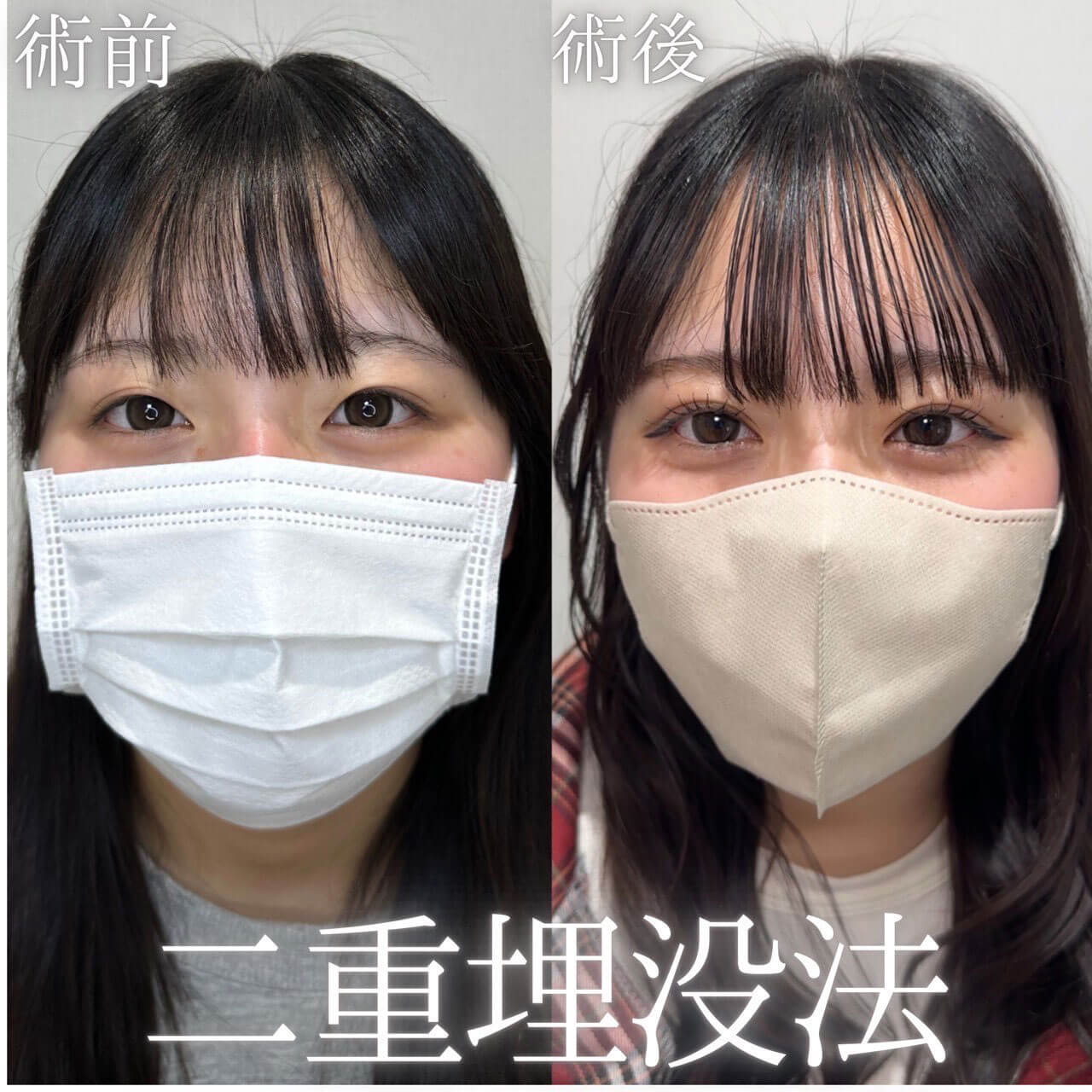 二重埋没法 症例06