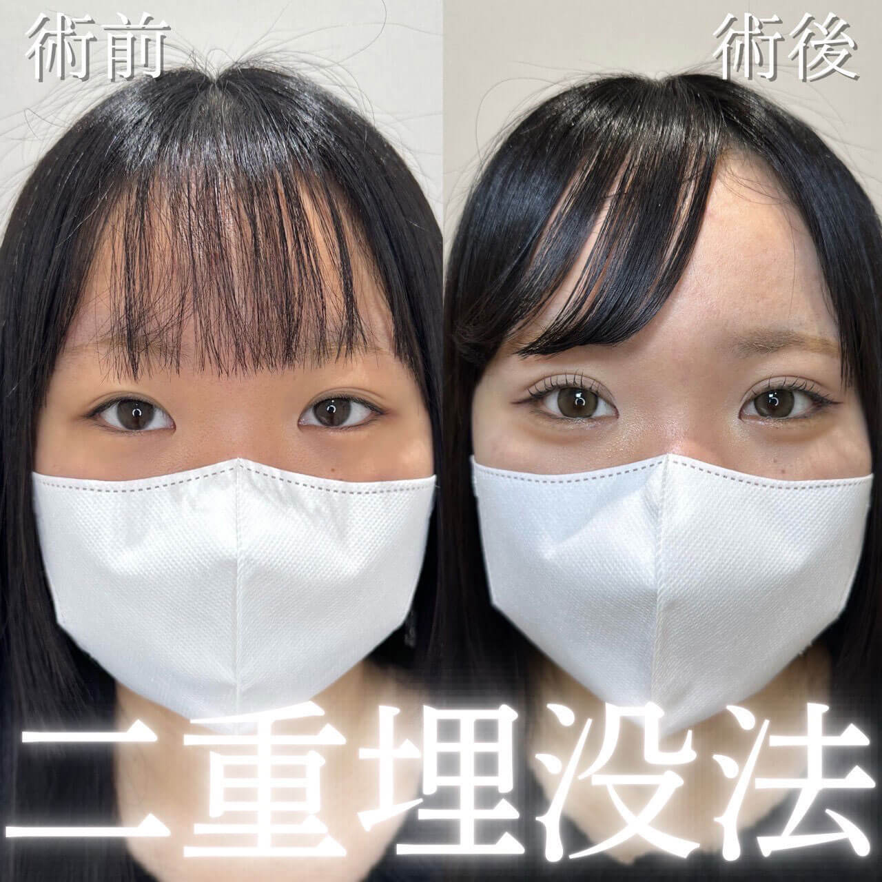 二重埋没法 症例07