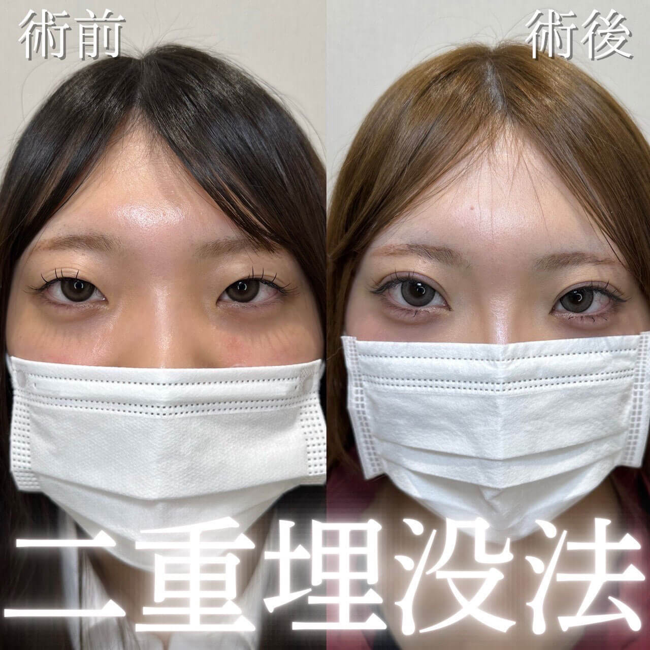 二重埋没法 症例08