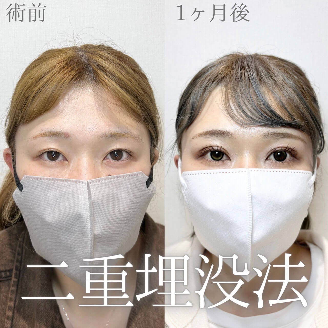 二重埋没法 症例10
