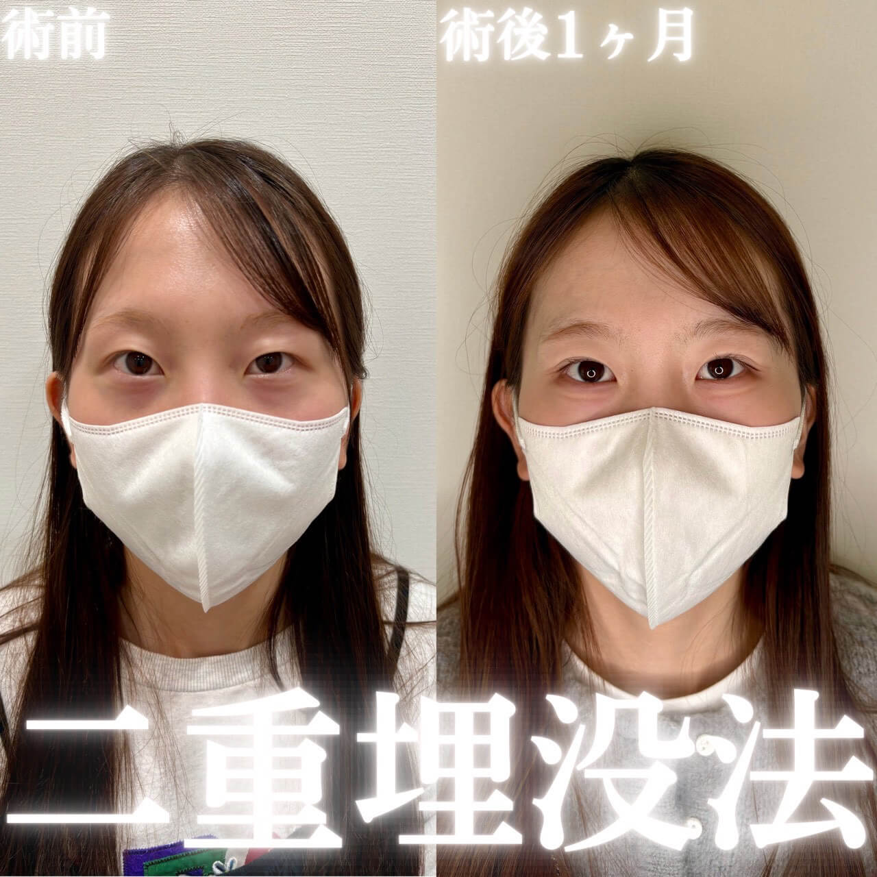 二重埋没法 症例11