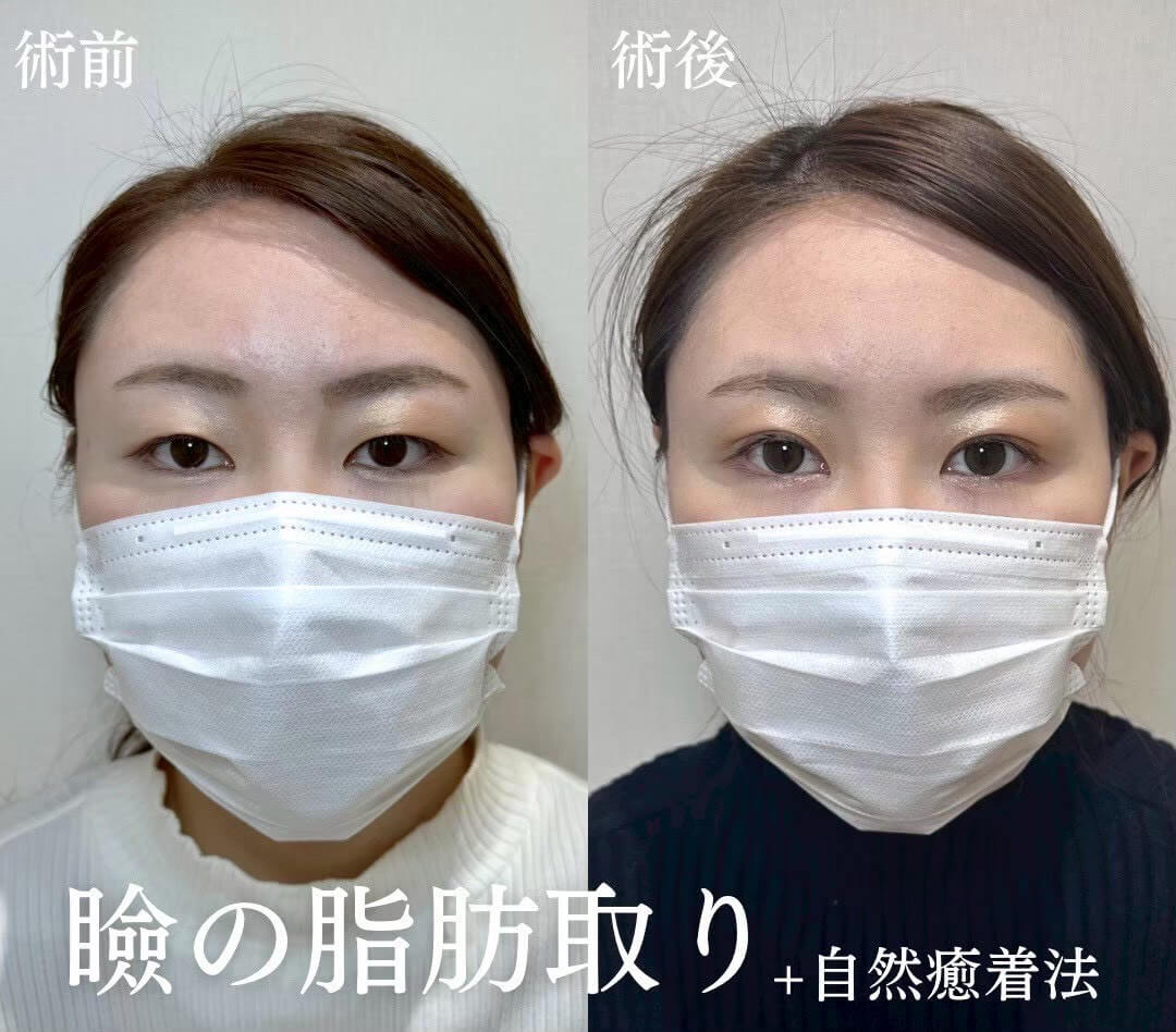 二重埋没法 症例12