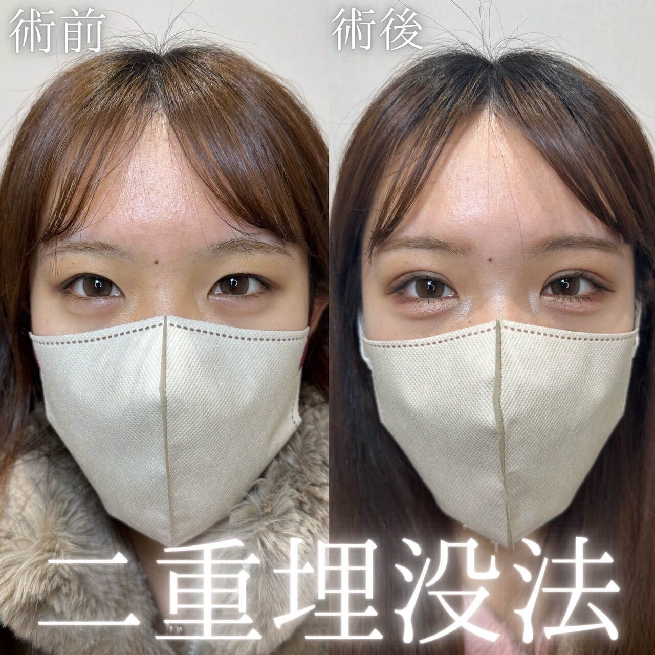 二重埋没法 症例13