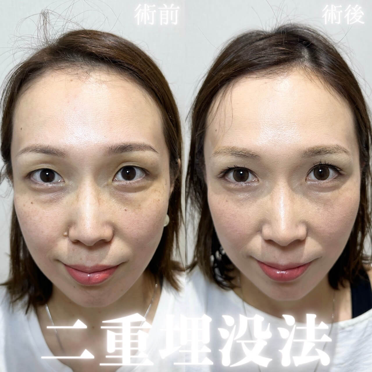 二重埋没法 症例14