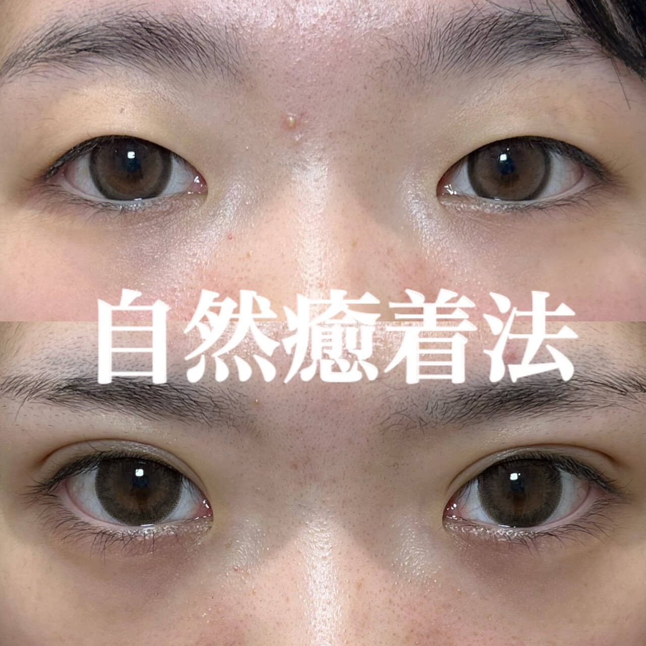 二重埋没法 症例15