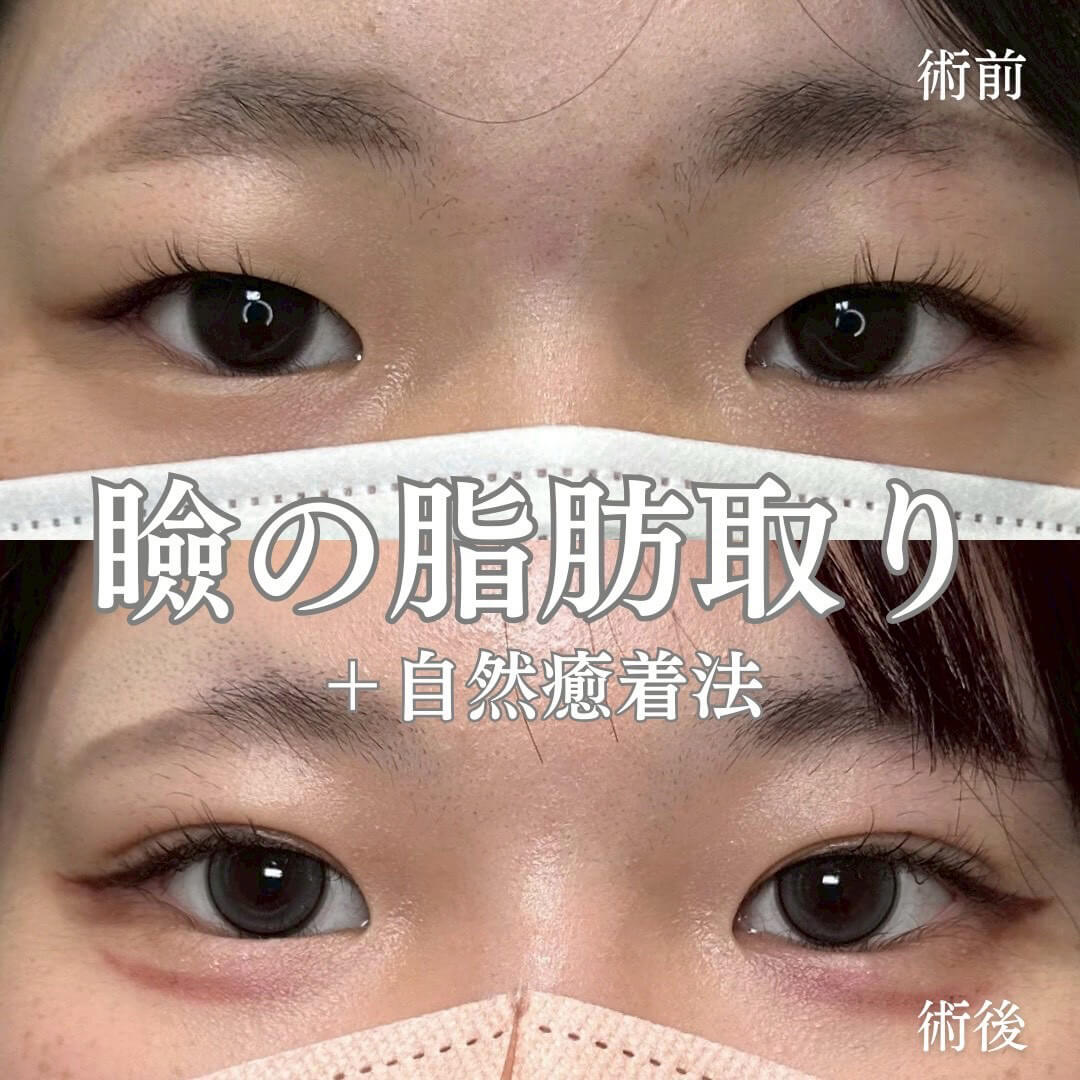 二重埋没法 症例16