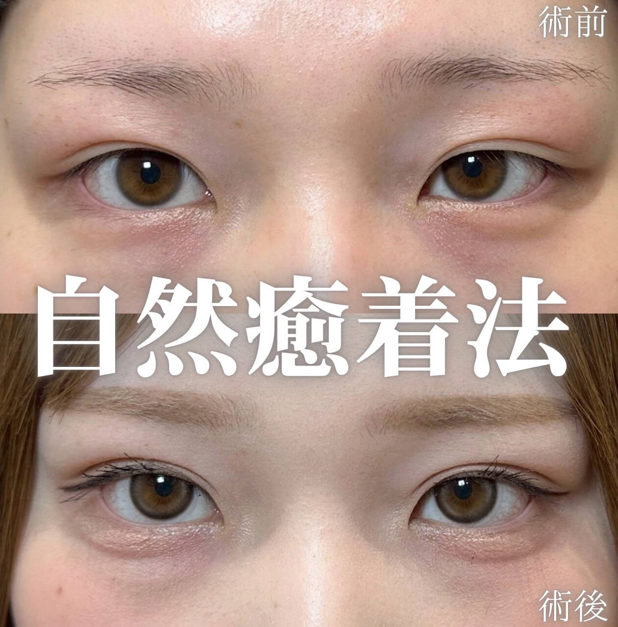 二重埋没法 症例17