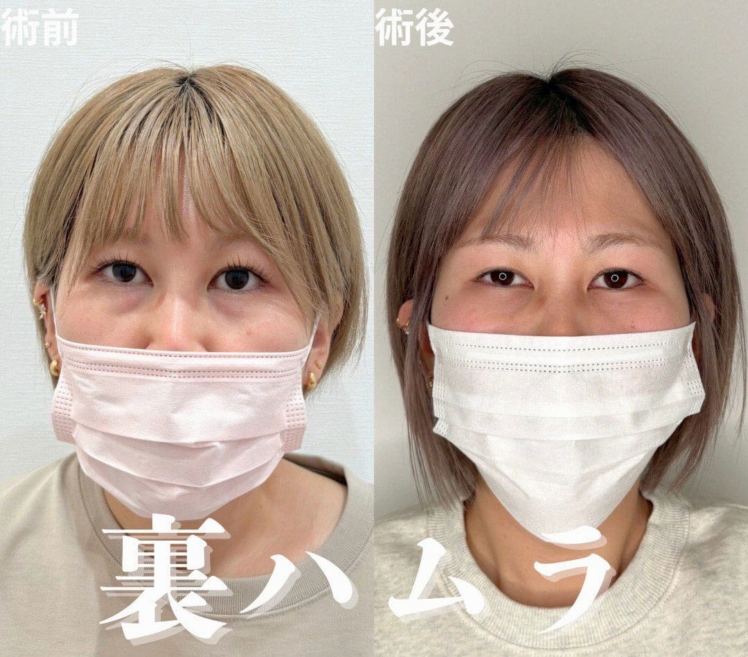 ハムラ法 症例01