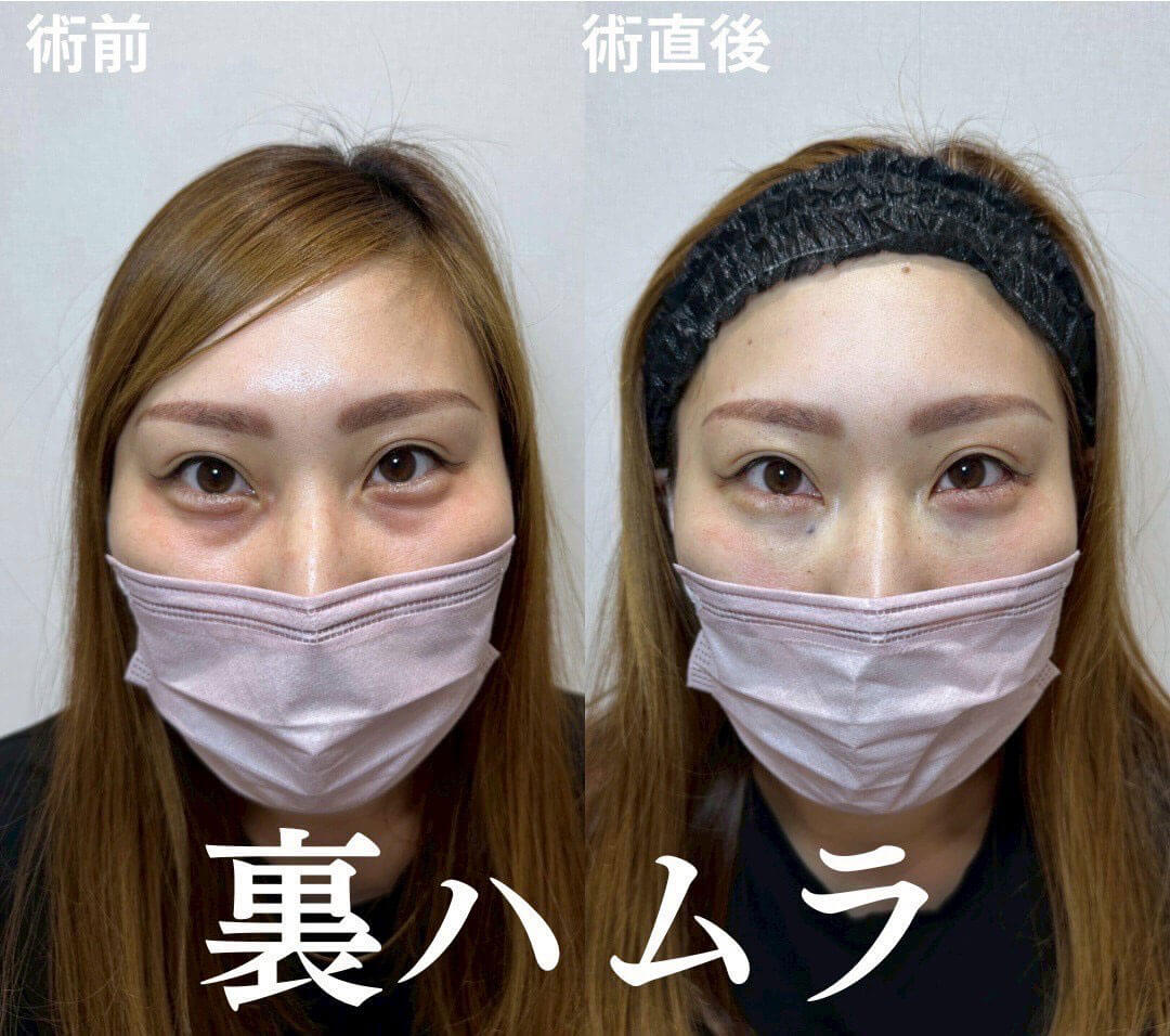 ハムラ法 症例02