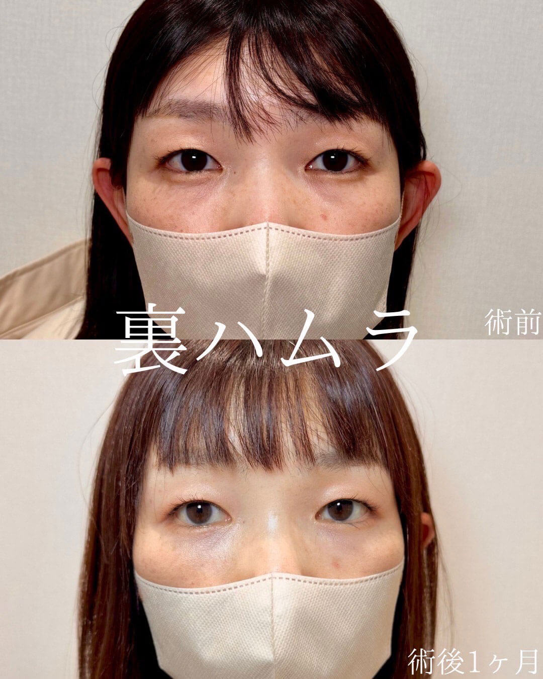 ハムラ法 症例03