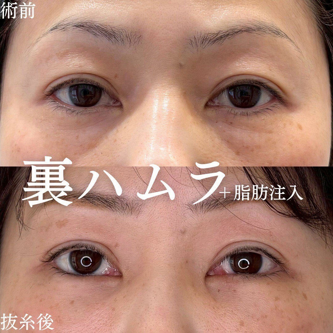 ハムラ法 症例04