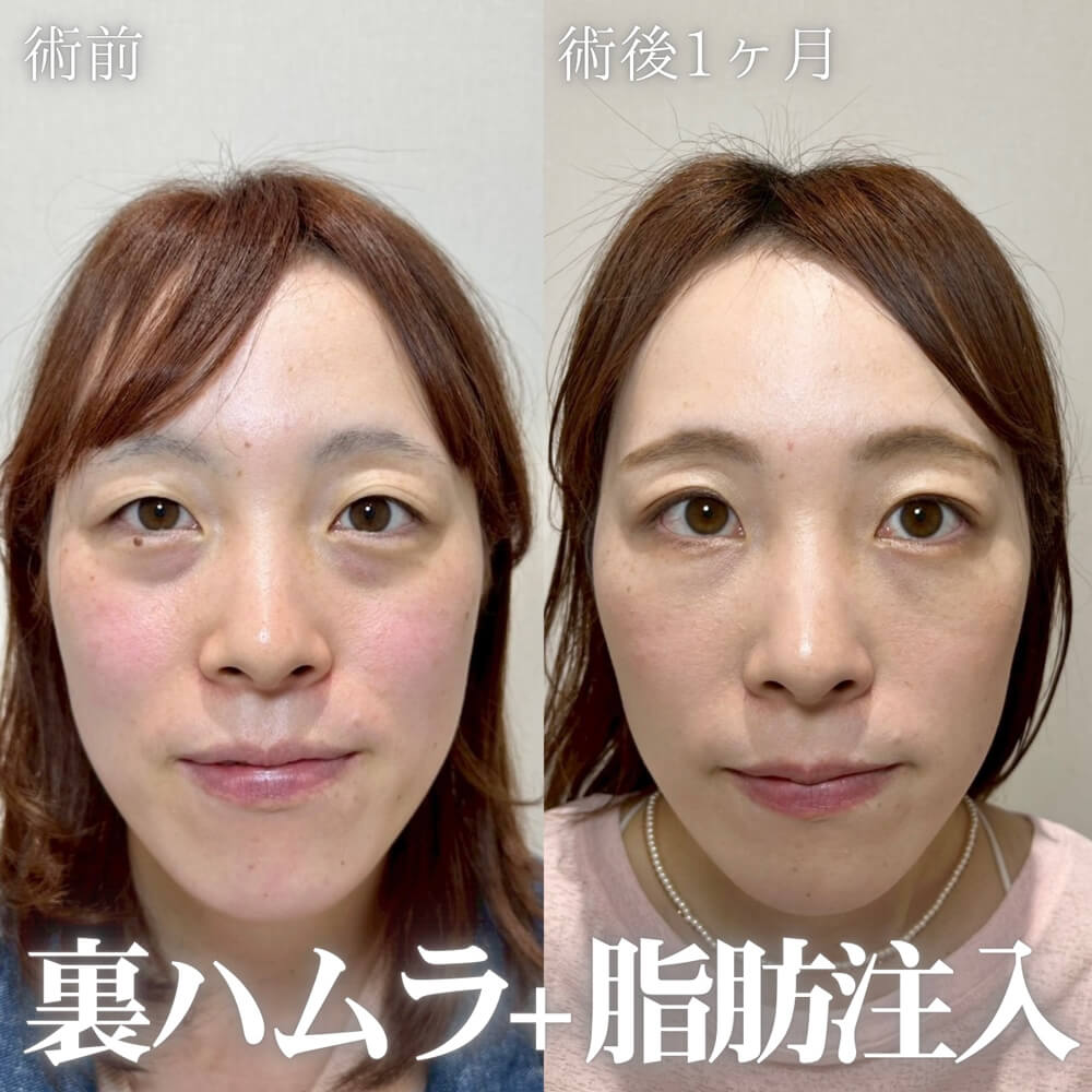 ハムラ法 症例10