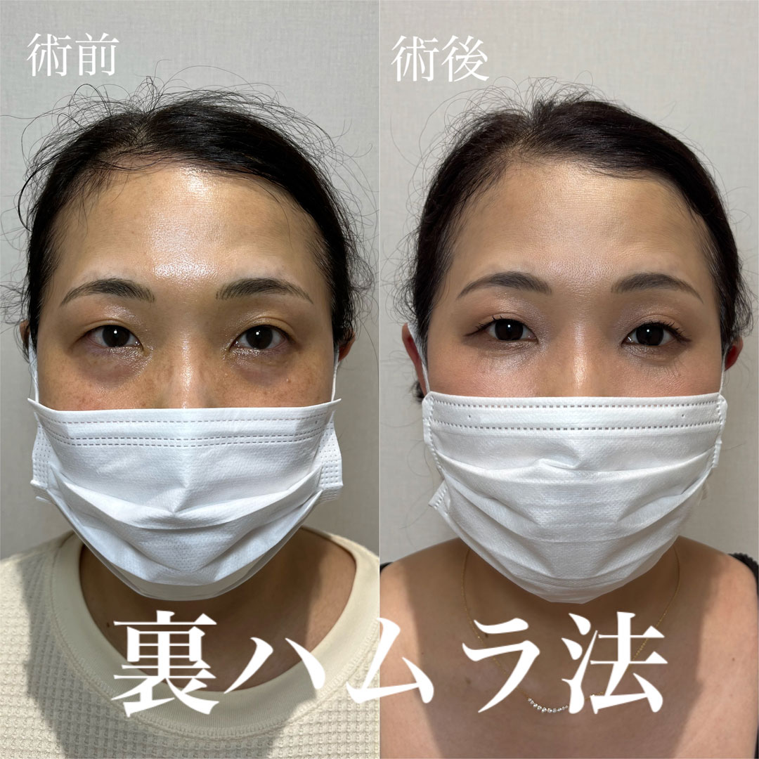 ハムラ法 症例11