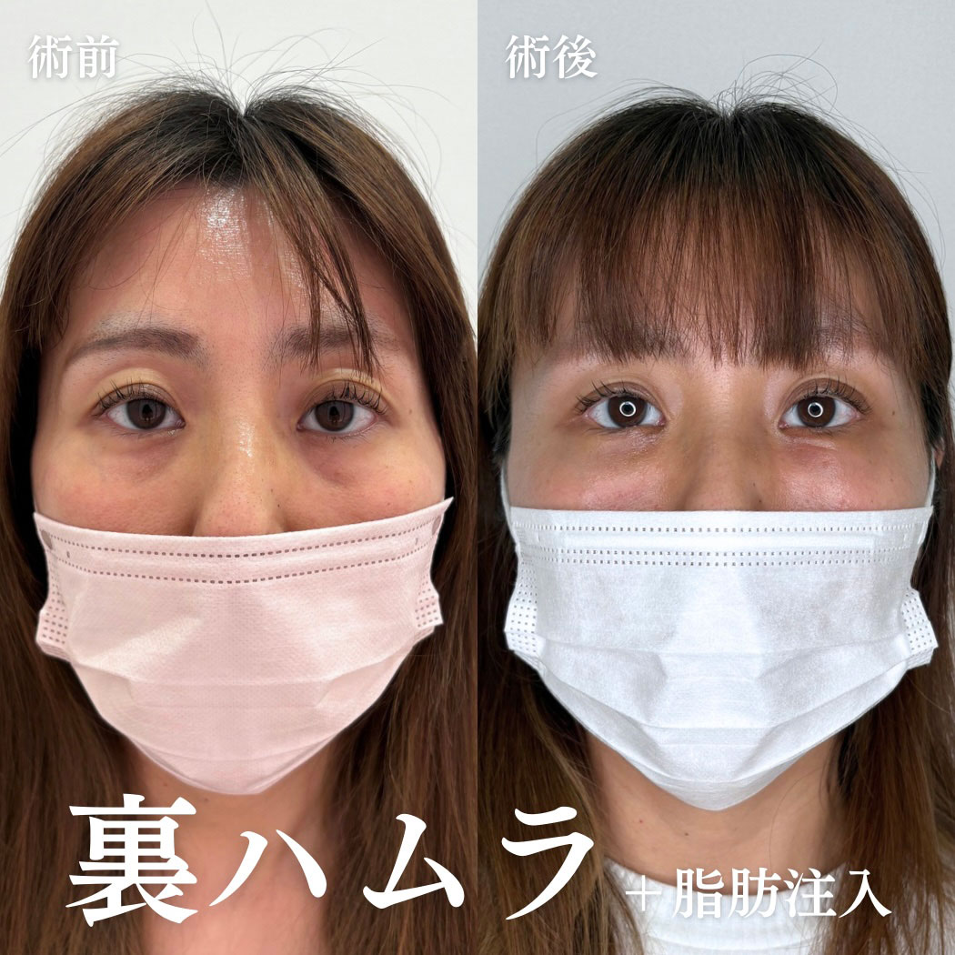 ハムラ法 症例12