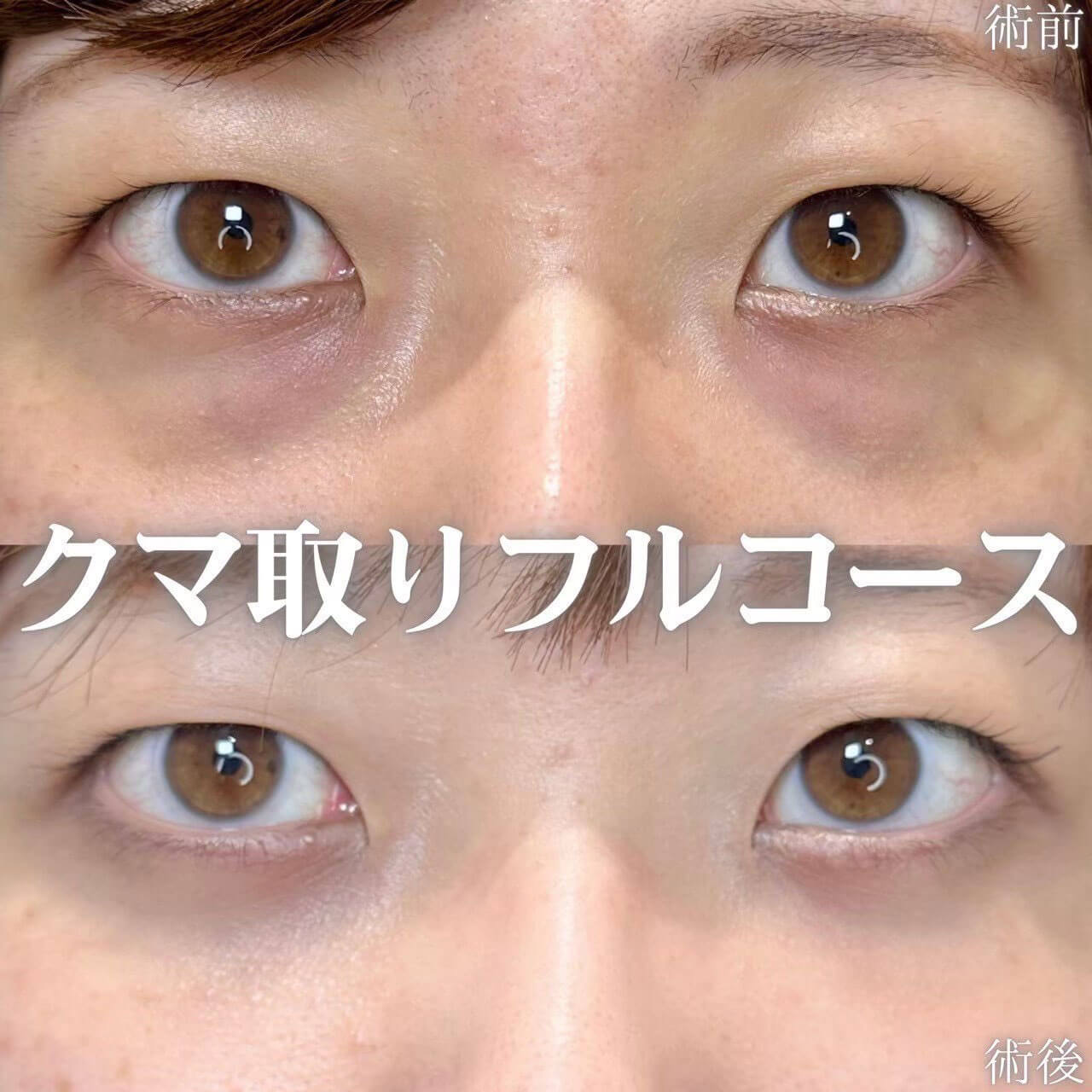 クマ取り 症例01