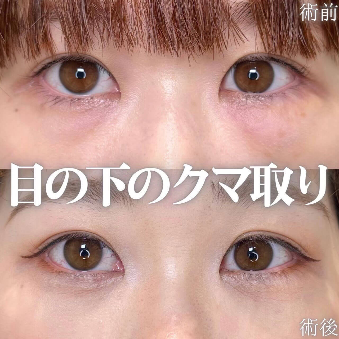 クマ取り 症例02