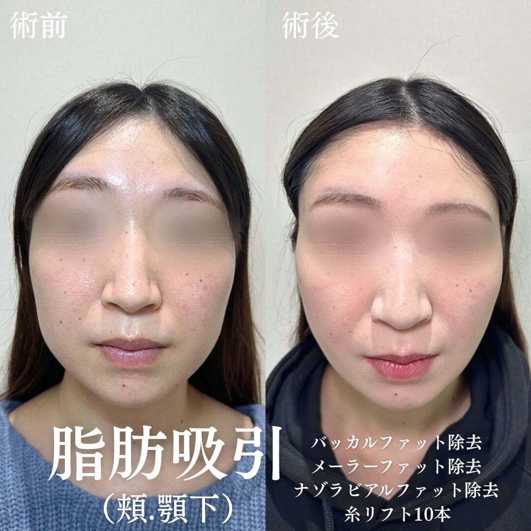 小顔治療 症例01