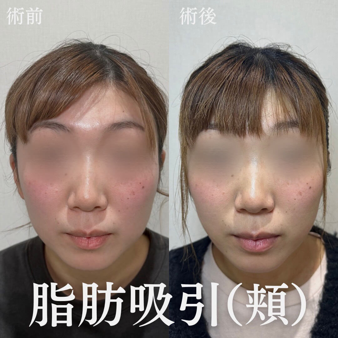 小顔治療 症例02