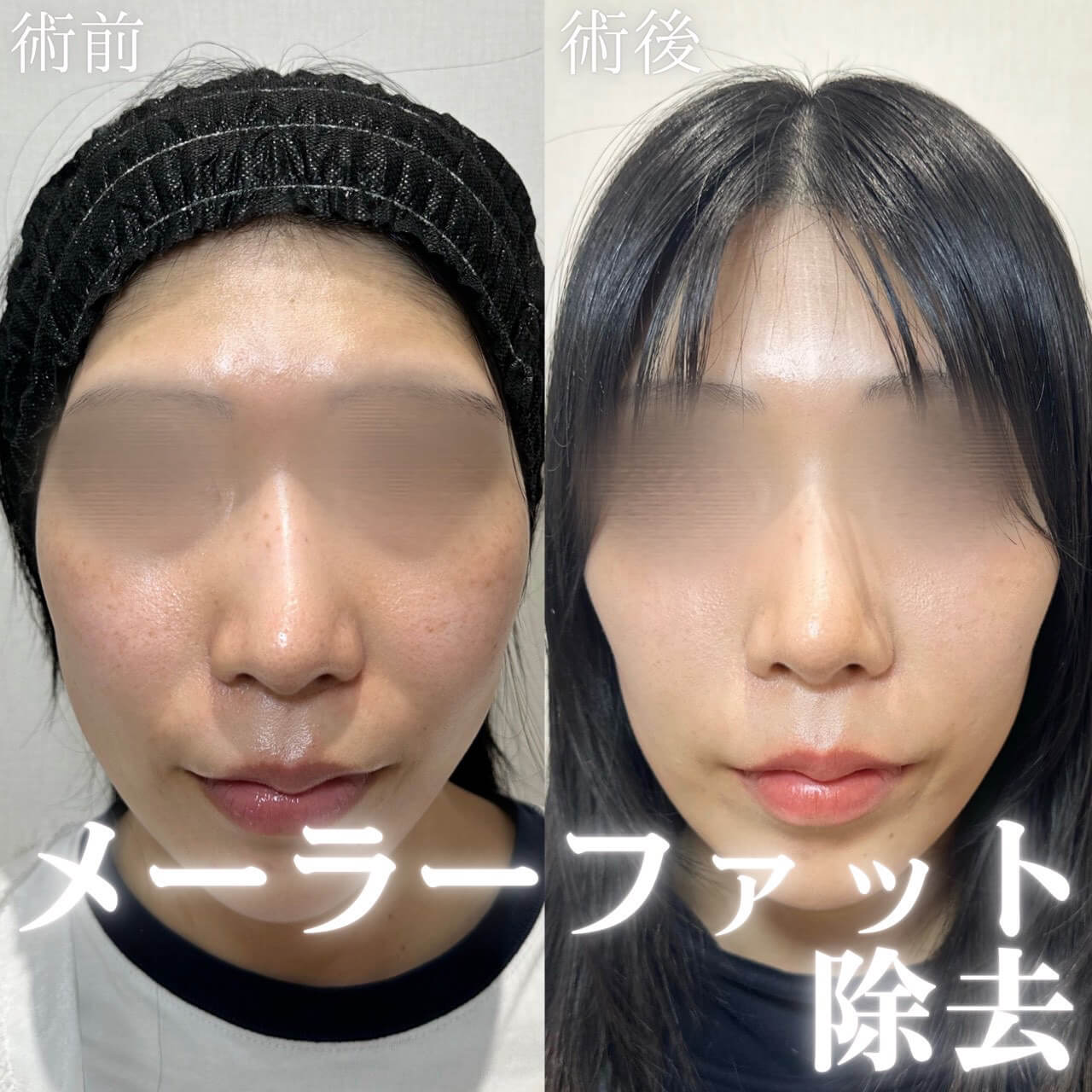 小顔治療 症例03