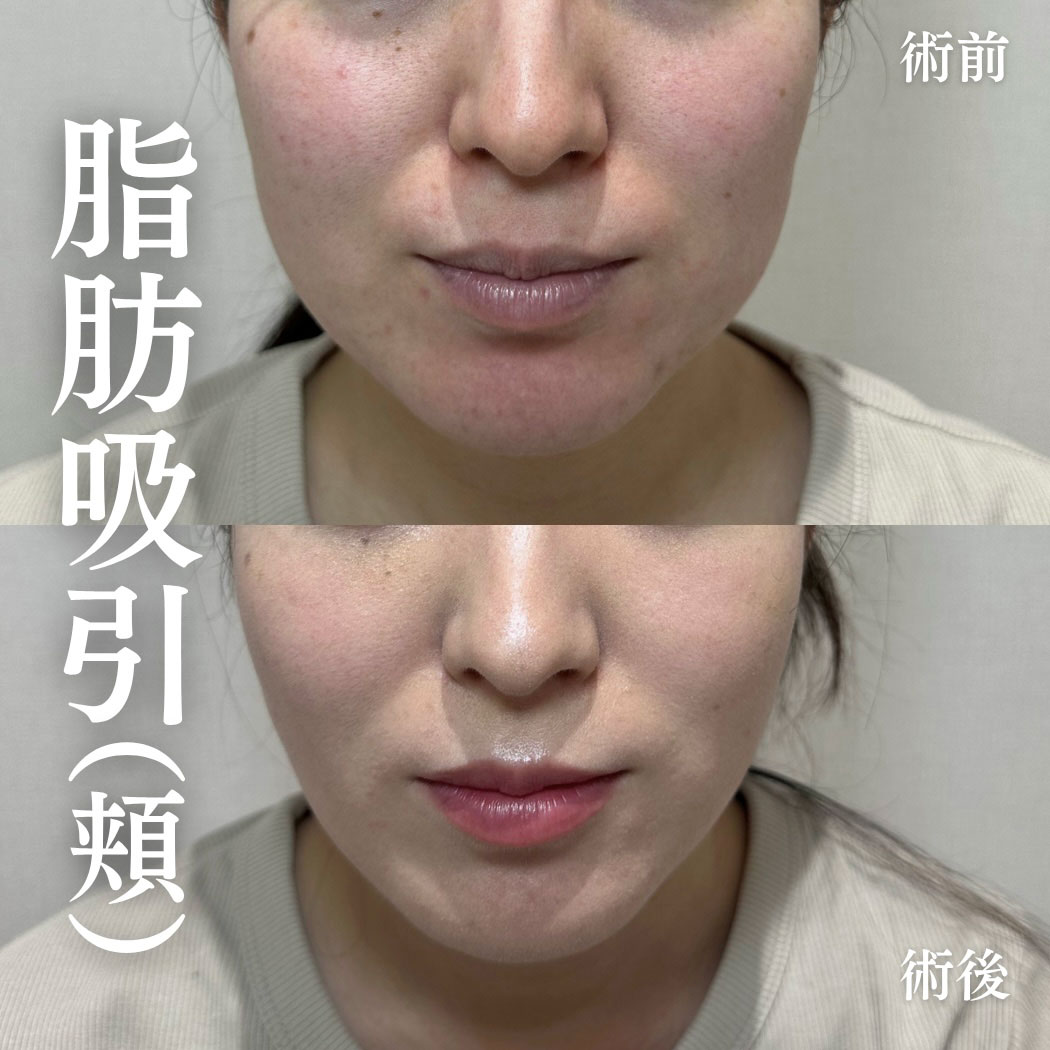 小顔治療 症例06