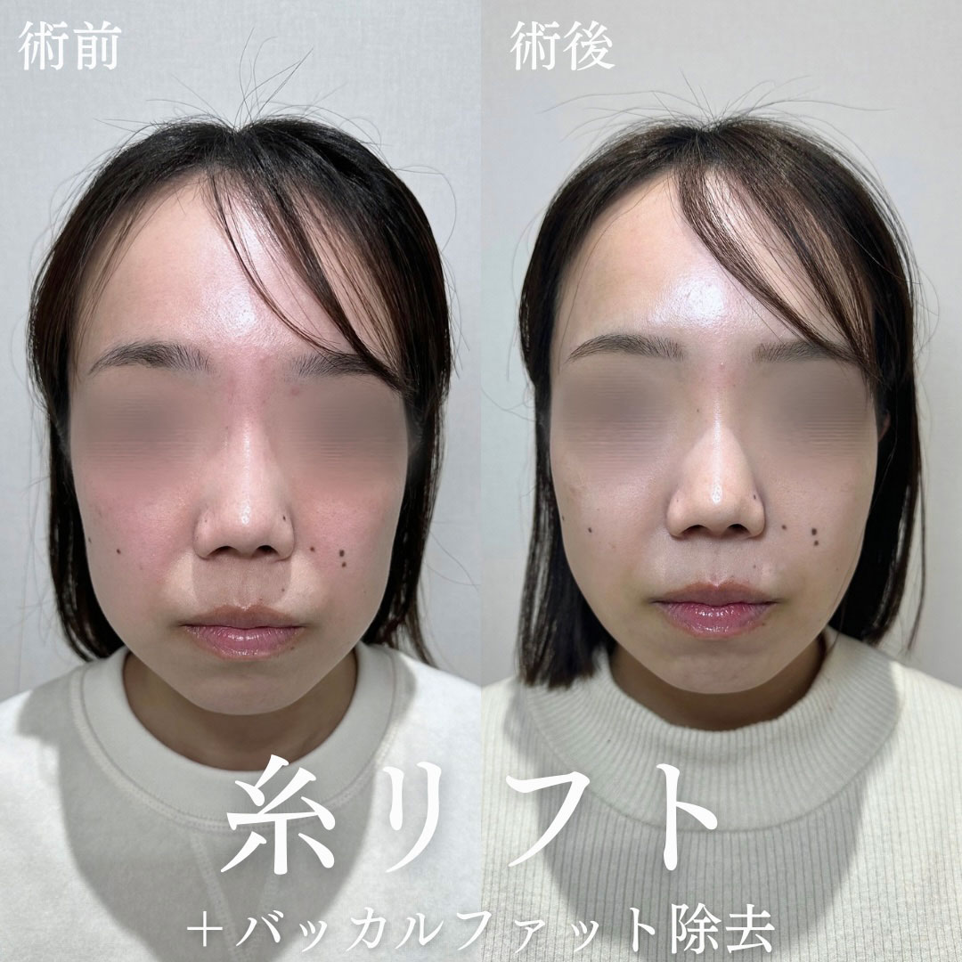 小顔治療 症例07