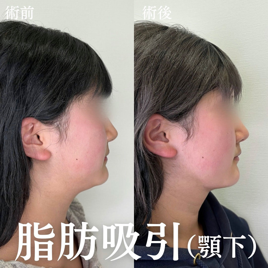 小顔治療 症例08