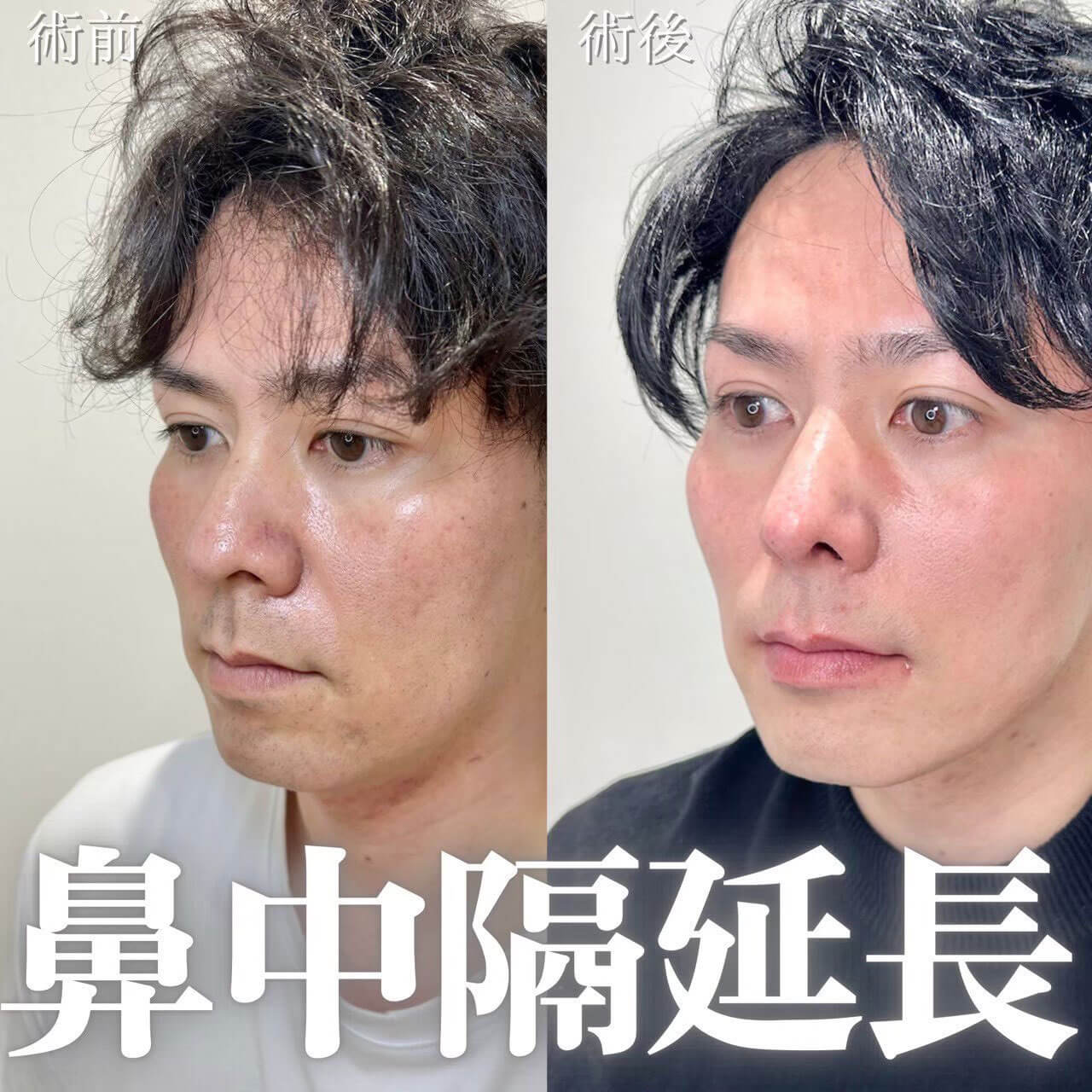 鼻整形 症例01
