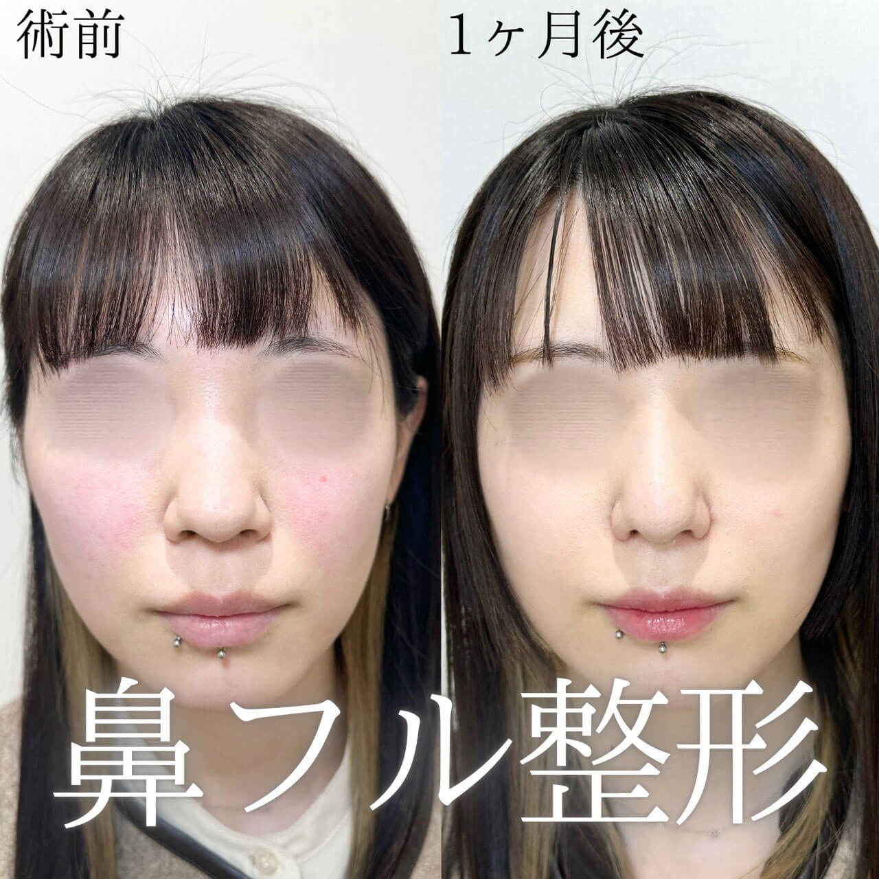 鼻整形 症例02