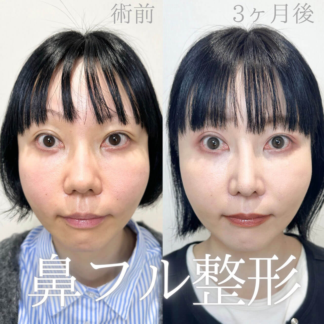 鼻整形 症例04