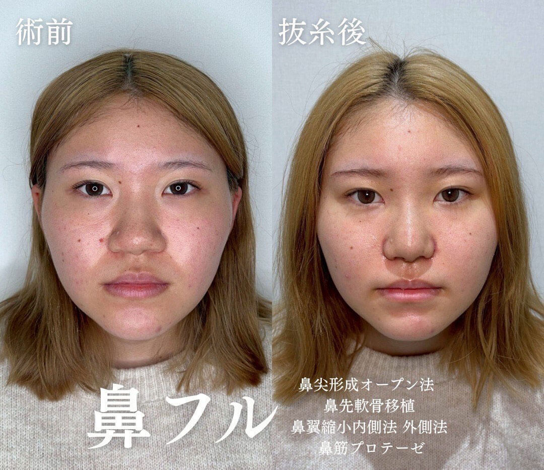 鼻整形 症例13