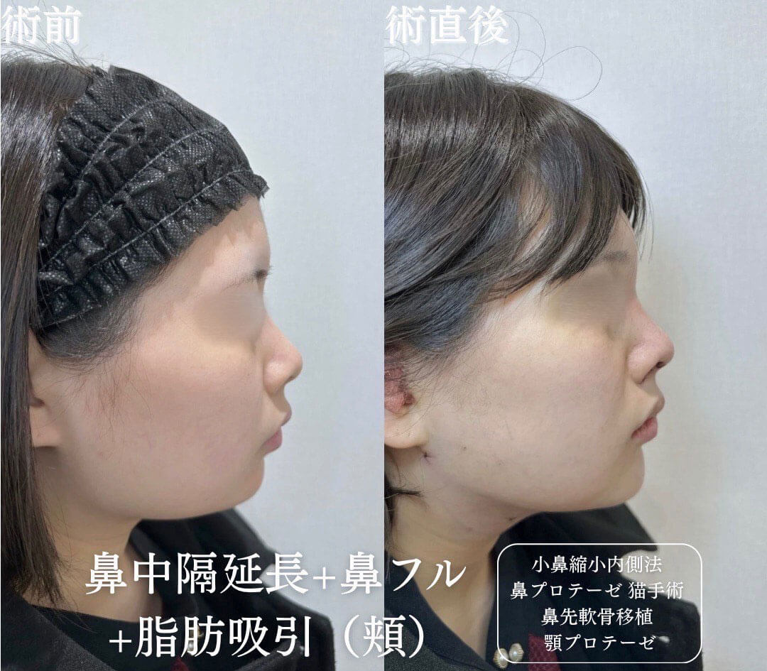 鼻整形 症例14