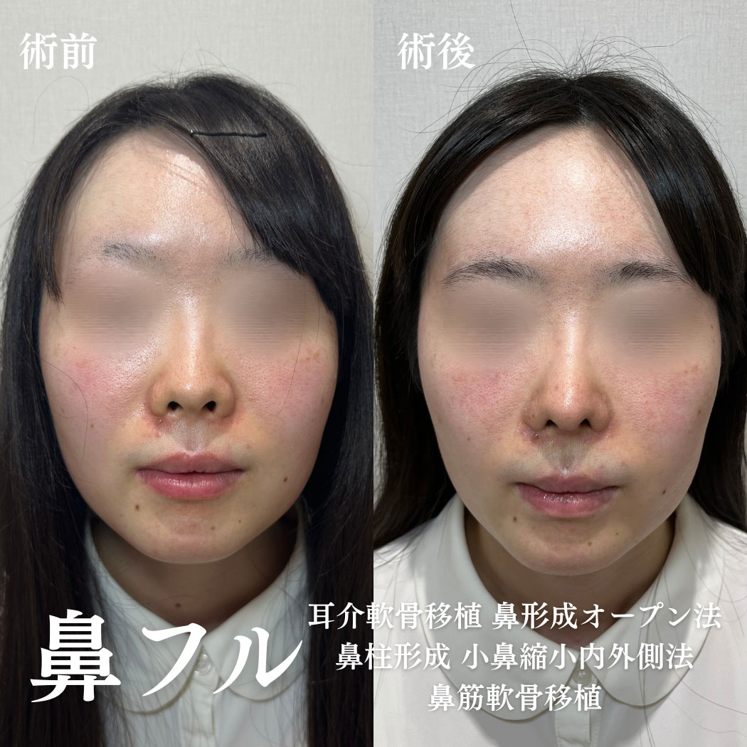 鼻整形 症例24