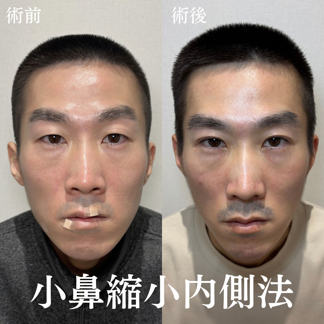 鼻整形 症例25