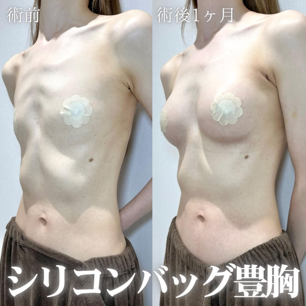 豊胸 症例03