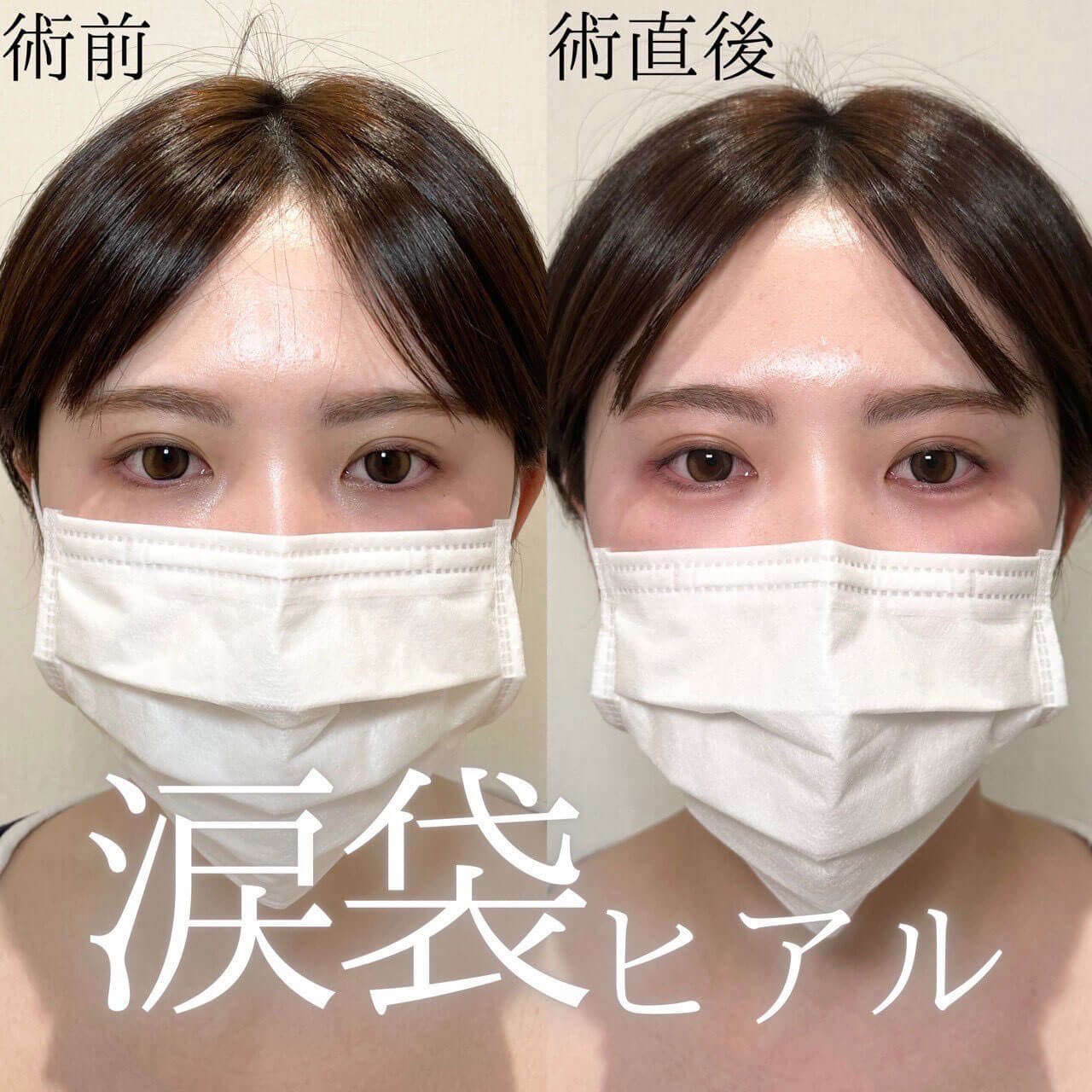 涙袋ヒアル