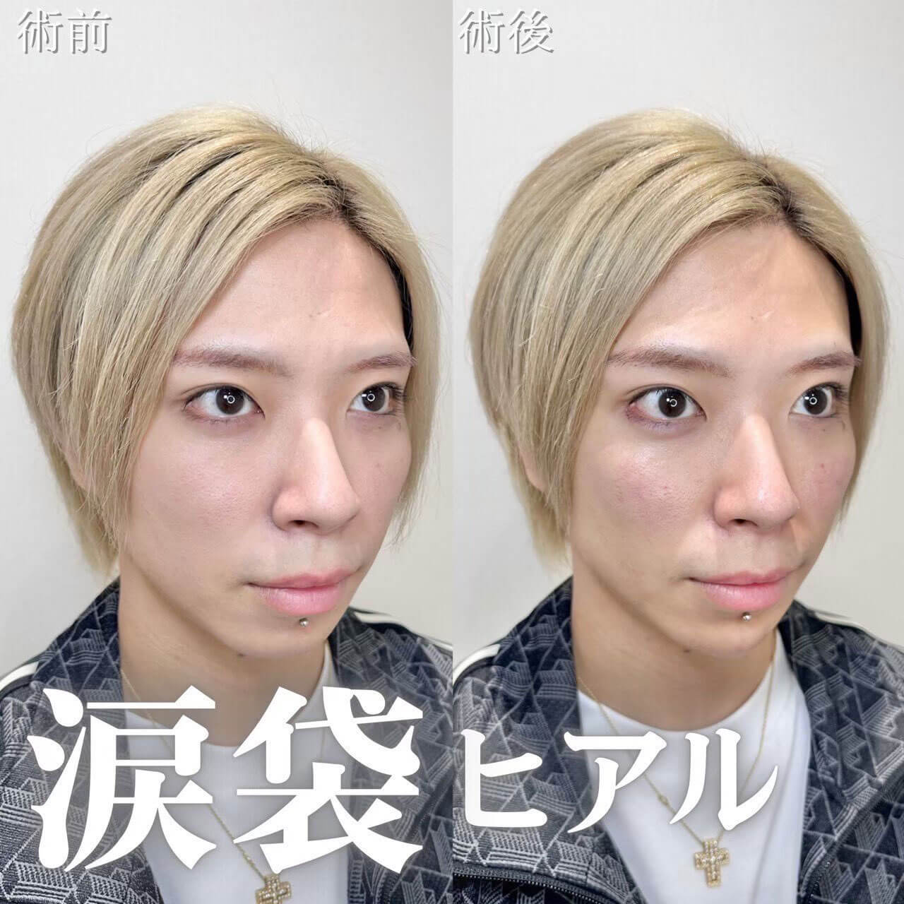 涙袋ヒアル