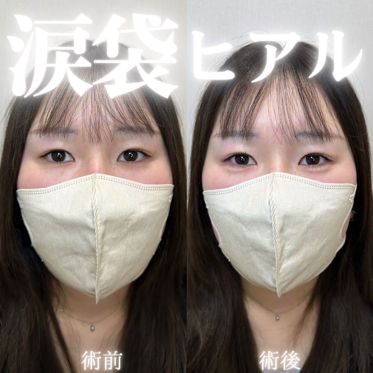 涙袋ヒアル