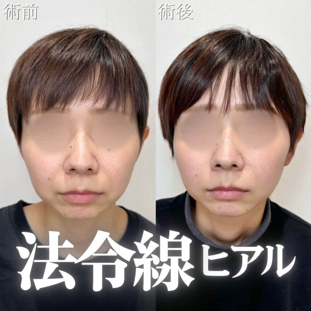 法令線ヒアル