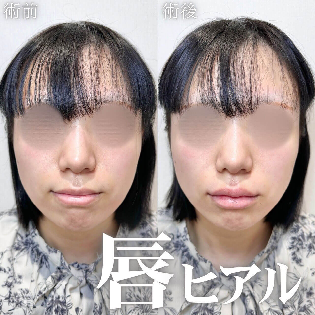 ヒアルロン酸 症例08