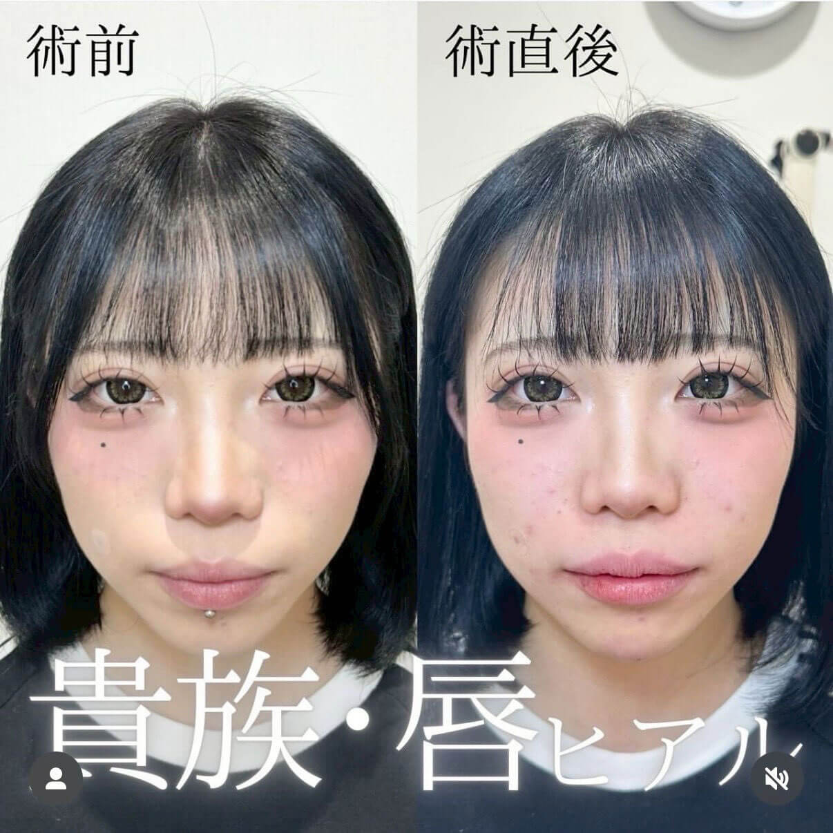 ヒアルロン酸 症例11