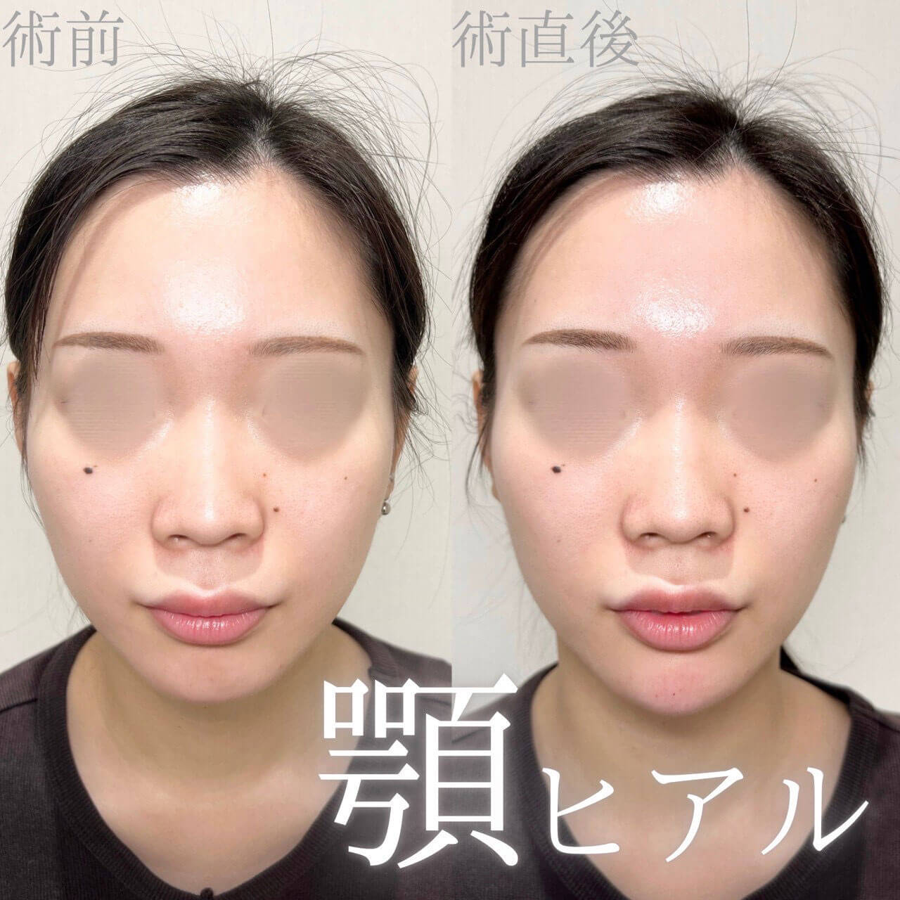 ヒアルロン酸 症例12