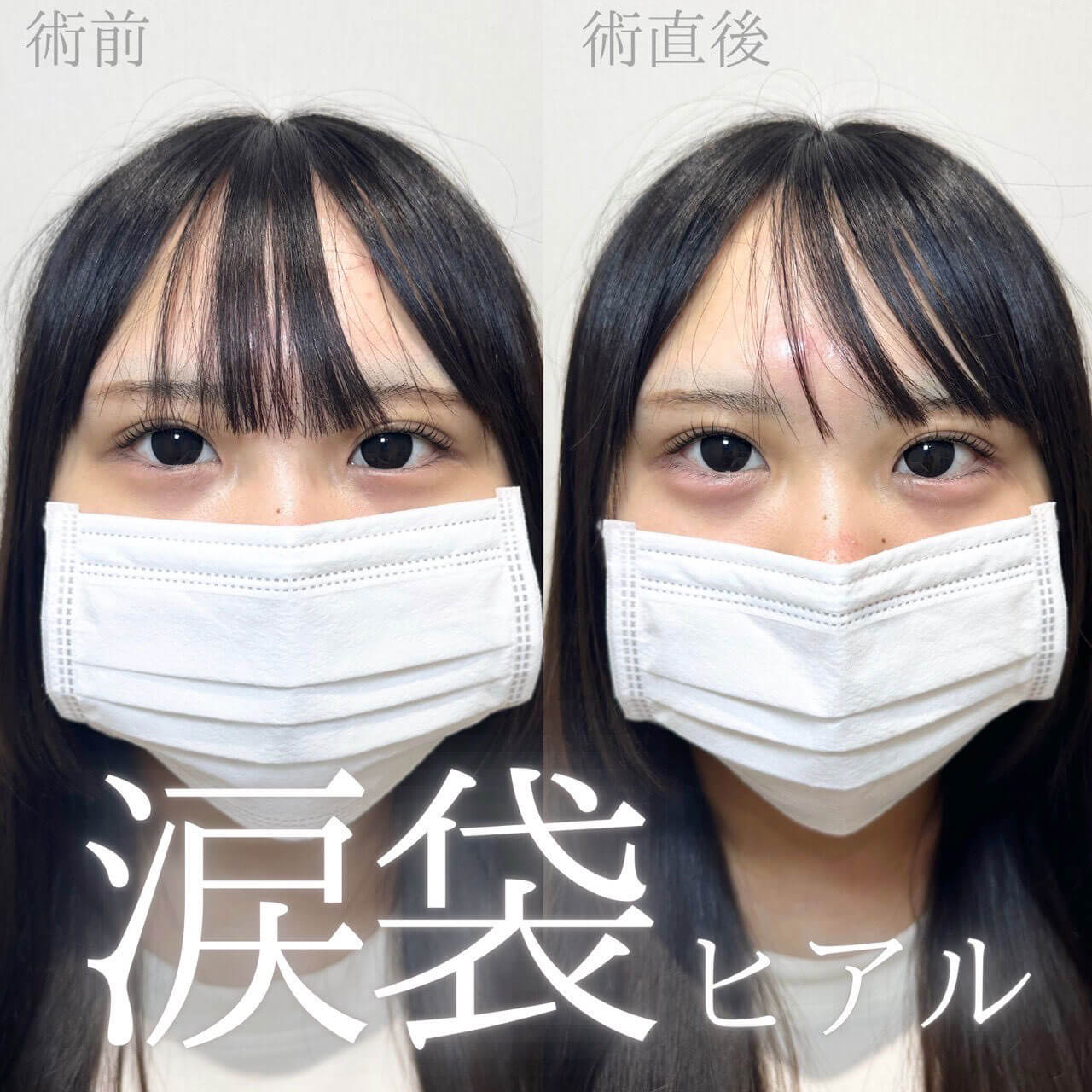 ヒアルロン酸 症例13