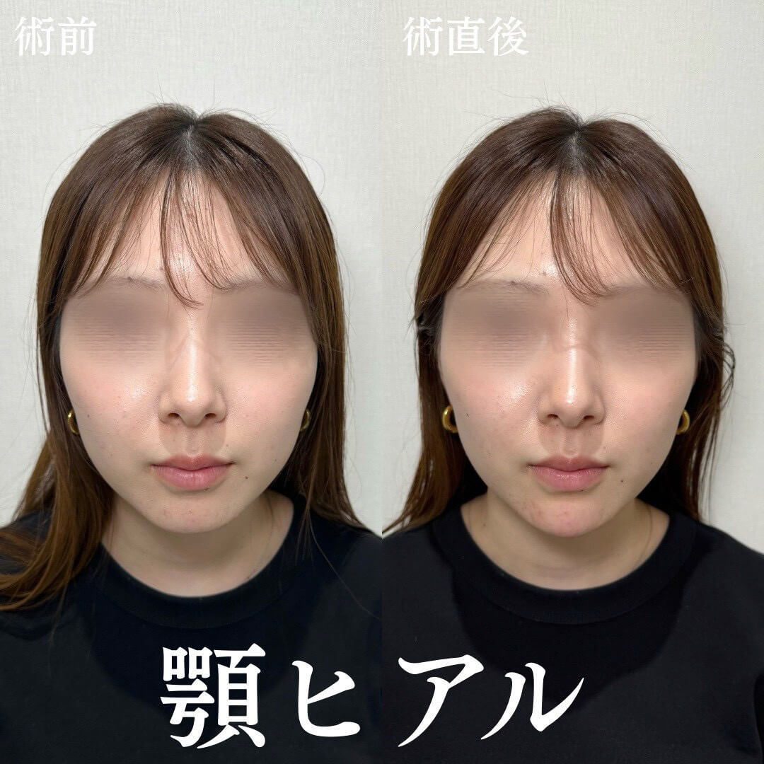 ヒアルロン酸 症例14